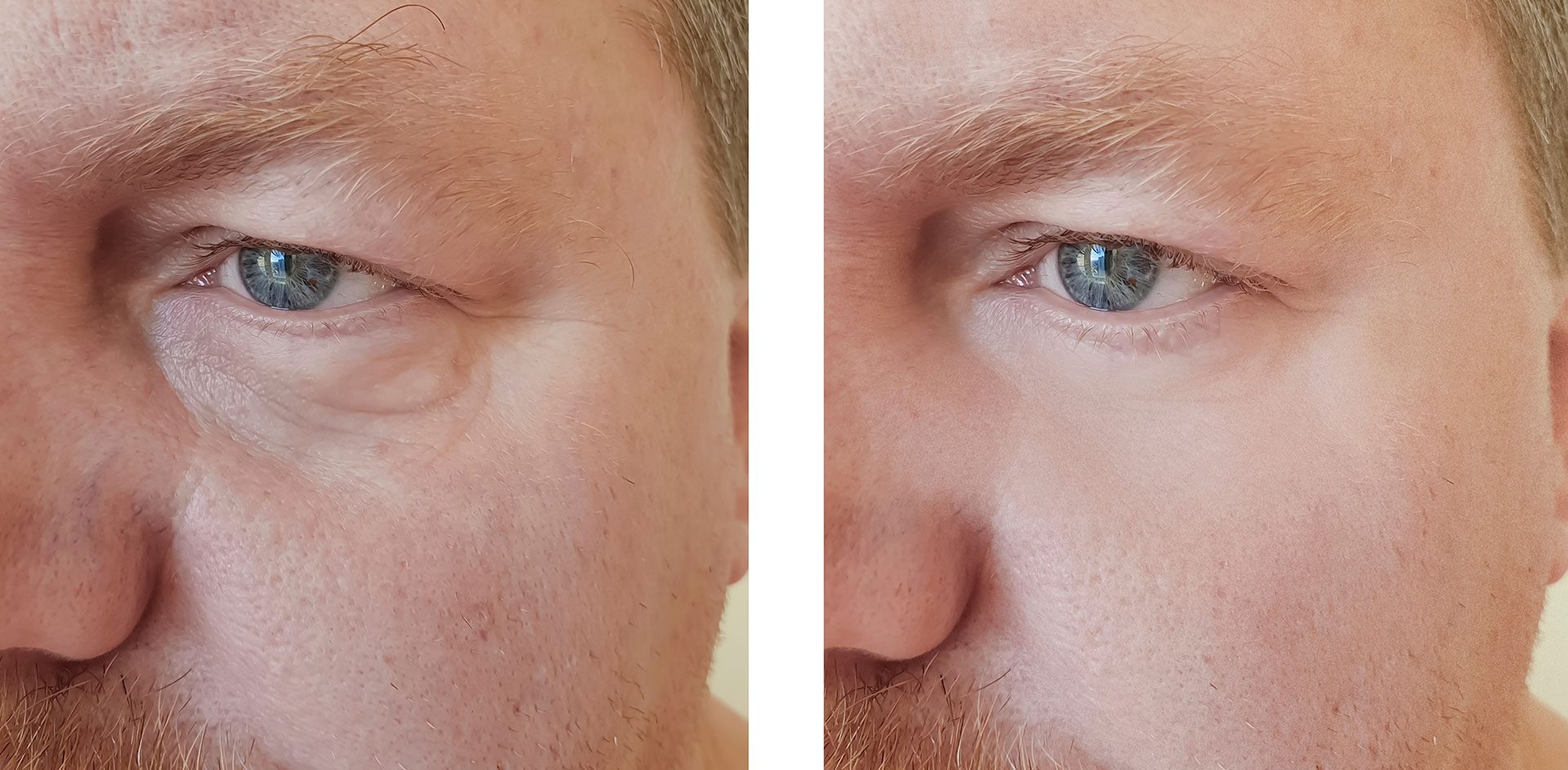 découvrez tout sur les injections : méthodes, types, avantages et inconvénients. obtenez des informations précises pour faire un choix éclairé sur les traitements par injection.