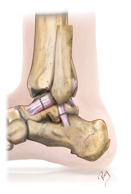découvrez tout sur la cheville : anatomie, blessures courantes, conseils de prévention et exercices de rééducation pour maintenir vos articulations en bonne santé.