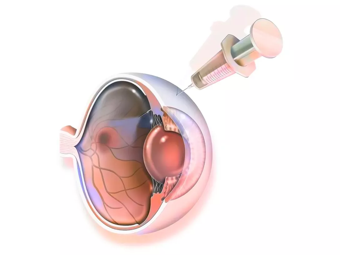 découvrez tout sur l'injection : définitions, types, méthodes et applications en médecine, cosmétique et bien d'autres domaines. informez-vous sur les bienfaits et les risques associés, ainsi que sur les dernières innovations en matière d'injection.