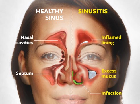 découvrez tout sur les sinus : leur anatomie, leurs fonctions, et comment soulager les problèmes liés aux sinus, tels que les infections et les allergies. informez-vous sur les traitements et les astuces pour maintenir une bonne santé nasale.